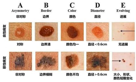 痣很凸|为什么身上突然长出新痣？容易恶变吗？